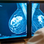 Almost half of women have dense breasts. So why are so few told