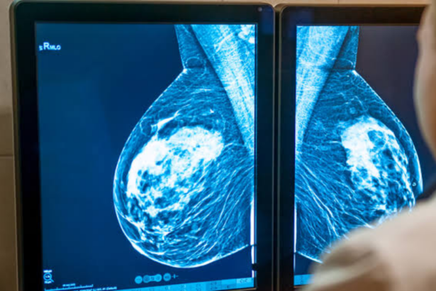 Almost half of women have dense breasts. So why are so few told